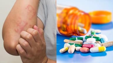 Uống thuốc chống dị ứng trong bao lâu thì dừng?