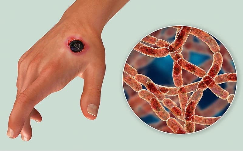 bệnh than do virus hay vi khuẩn gây ra