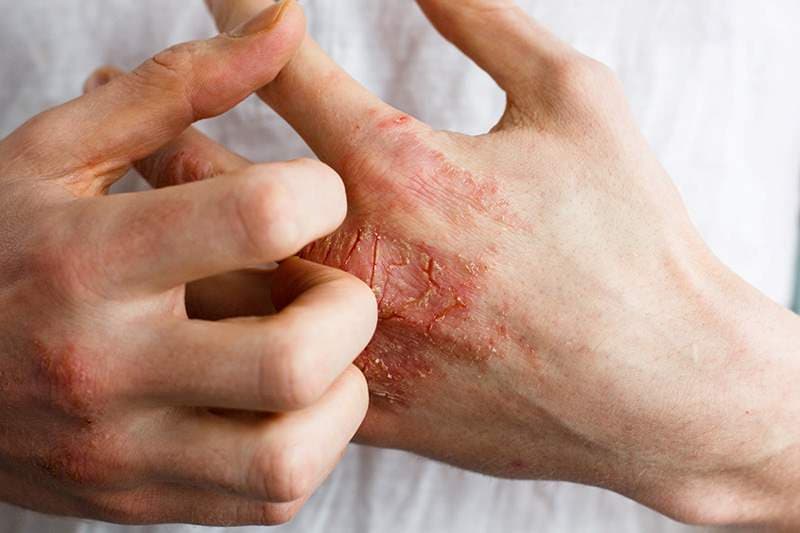 phác đồ điều trị viêm da tiếp xúc dị ứng