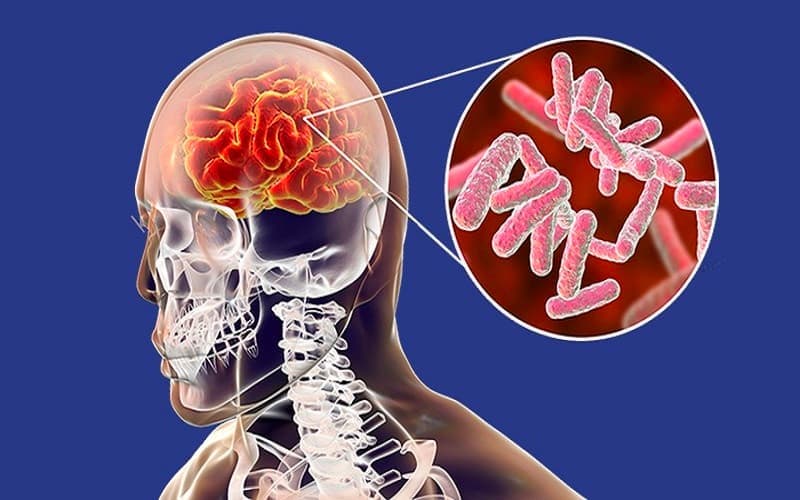 bệnh than do virus hay vi khuẩn gây ra