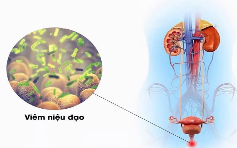 vi khuẩn mycoplasma gây bệnh gì