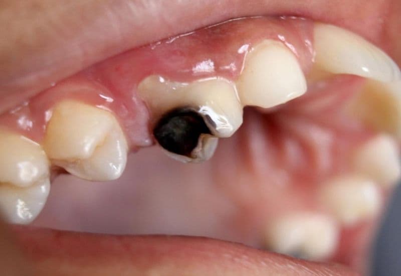 viêm tủy răng không hồi phục