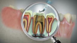Viêm tủy răng không hồi phục là gì?