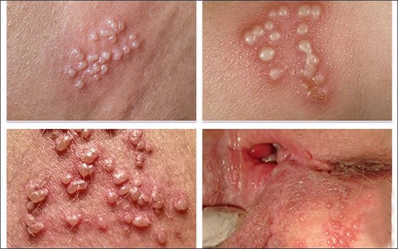 bệnh lậu xét nghiệm máu có ra không