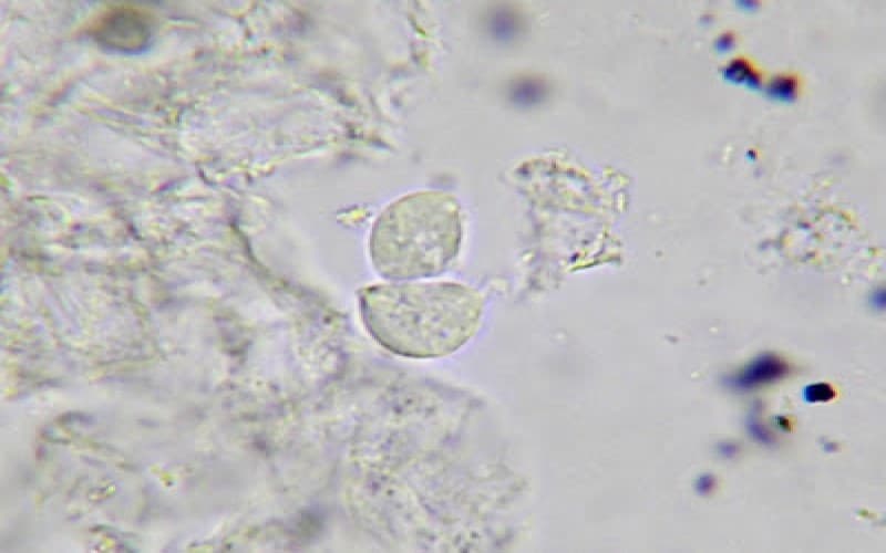 Trichomonas vagіnalis gây bệnh gì