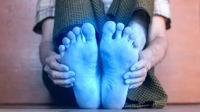 Bàn chân lạnh dấu hiệu bệnh gì