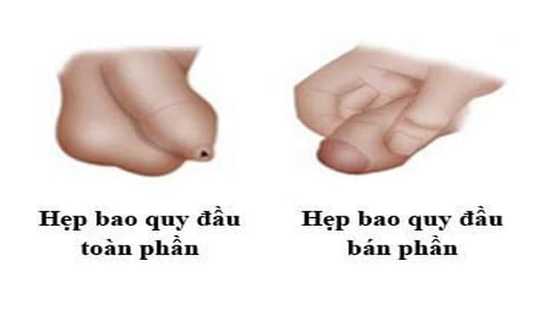 hẹp bao quy đầu