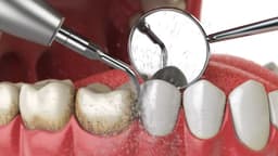 Bà bầu lấy cao răng được không?