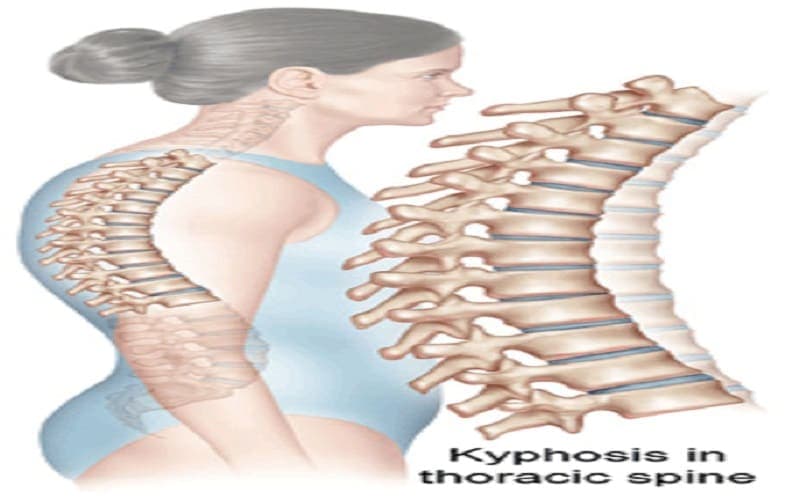 Gù lưng có di truyền không?