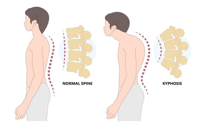 Gù lưng có di truyền không?