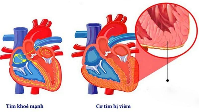 dấu hiệu bệnh quai bị ở nam