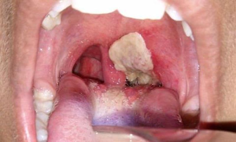 dấu hiệu bệnh bạch hầu ở trẻ em