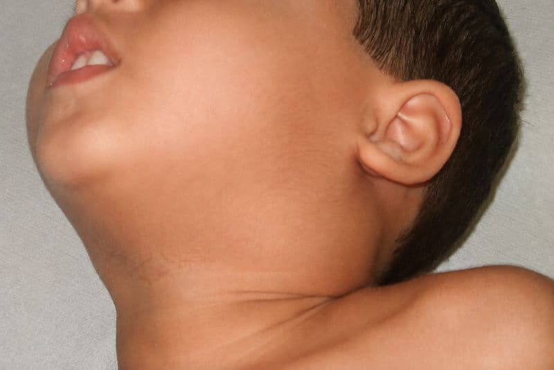 dấu hiệu bệnh bạch hầu ở trẻ em