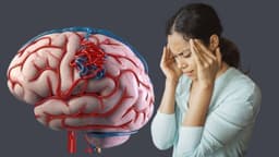 Biểu hiện dị dạng mạch máu não