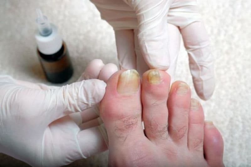 Dấu hiệu bệnh qua móng chân    
