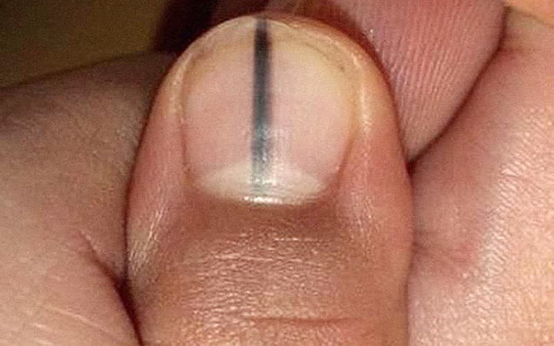 dấu hiệu bệnh qua móng tay