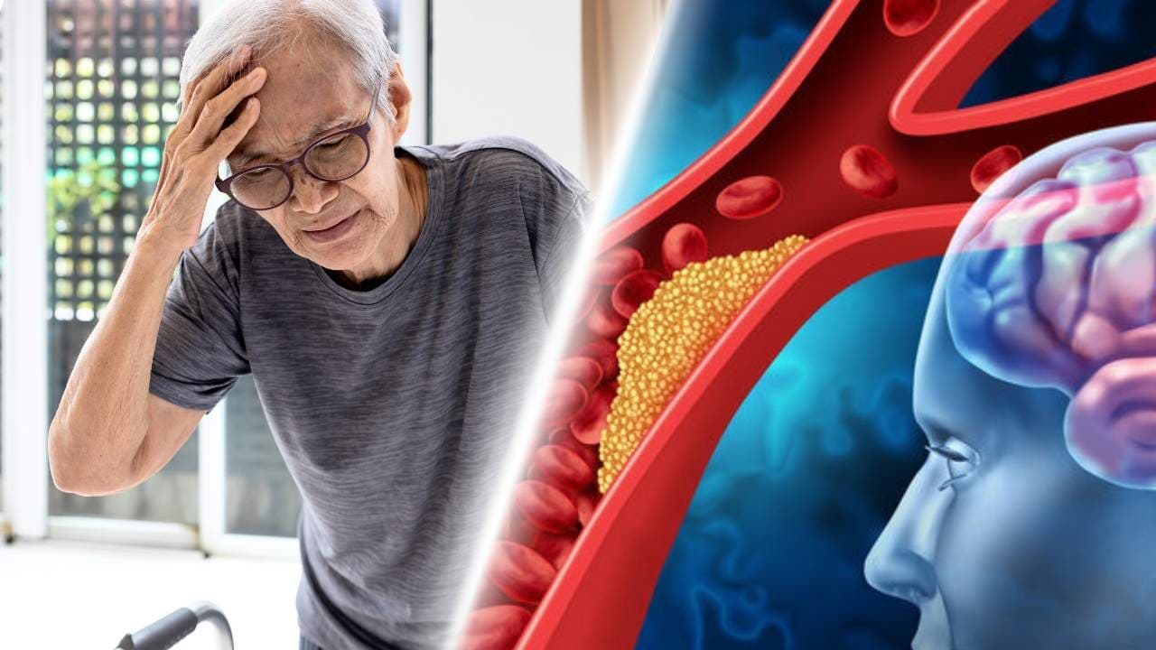 các giai đoạn nhồi máu não trên mri