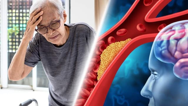Các giai đoạn nhồi máu não trên MRI