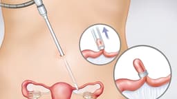 Các phương pháp triệt sản nữ