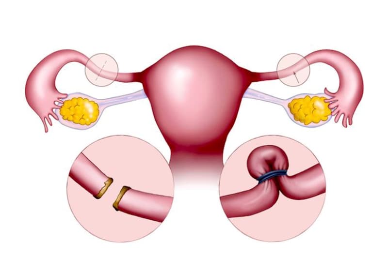 Các phương pháp triệt sản nữ
