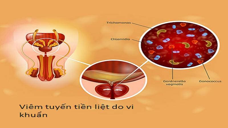 thuốc trị viêm tuyến tiền liệt