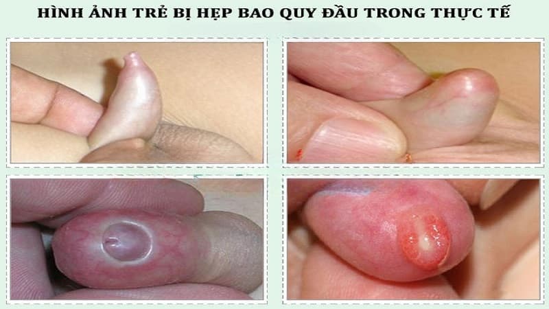 bao quy đầu trẻ em bình thường