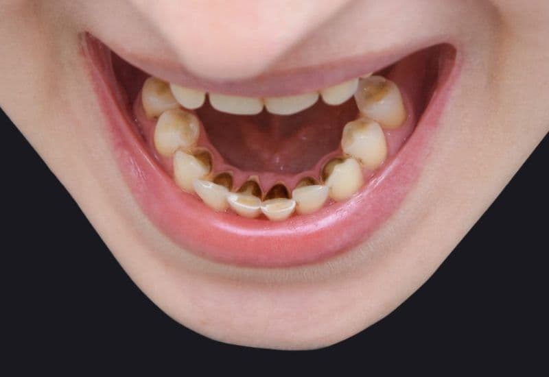 cách loại bỏ cao răng lâu năm