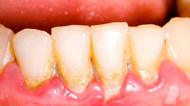 Cách loại bỏ cao răng lâu năm hiệu quả