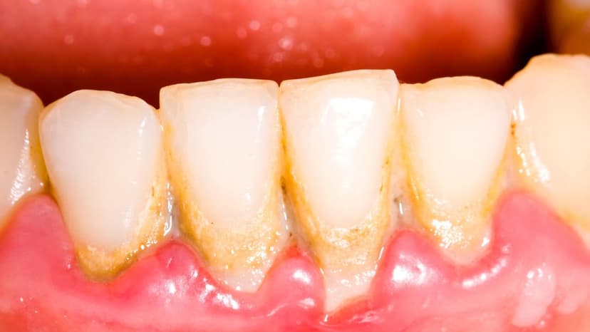 Cách loại bỏ cao răng lâu năm hiệu quả