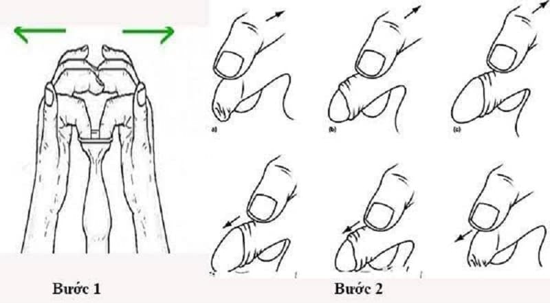 lột bao quy đầu là gì