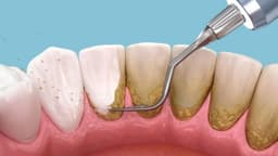 Cao răng đen ở chân răng có nguy hiểm?