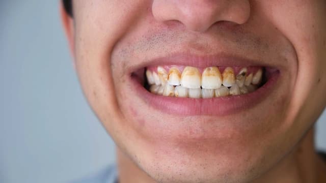 Cao răng tự rơi ra có tốt không?