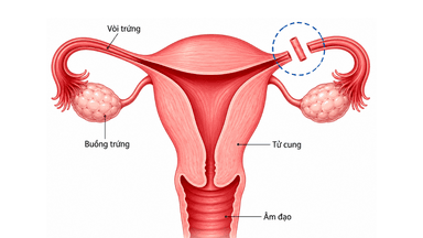 Chỉ định cắt vòi trứng triệt sản