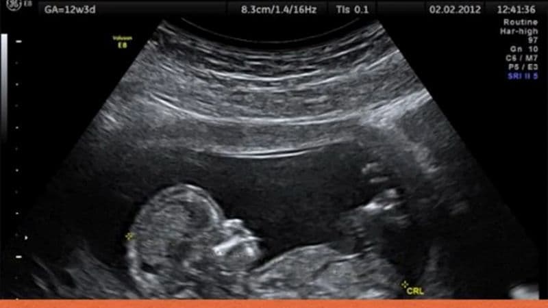 chiều dài xương mũi thai 14 tuần