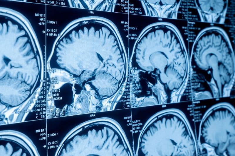 chụp MRI não có nguy hiểm không