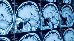 Chụp MRI não có nguy hiểm không?