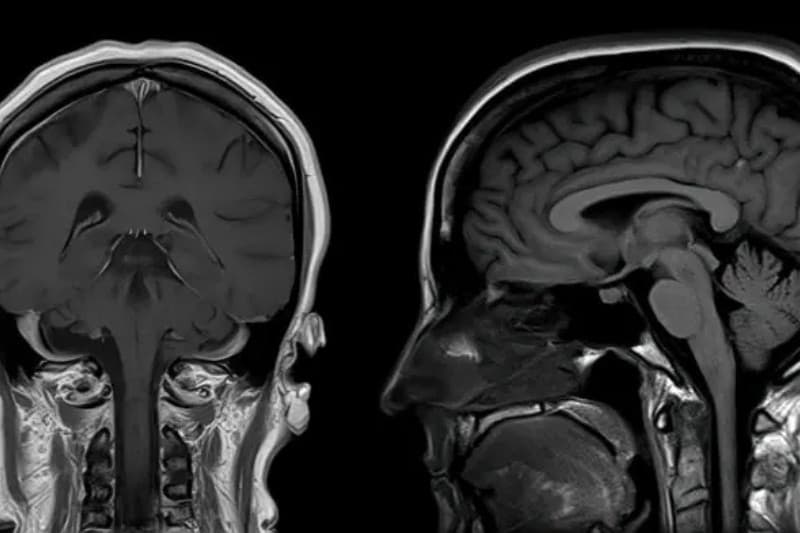 chụp mri não bao nhiêu phút