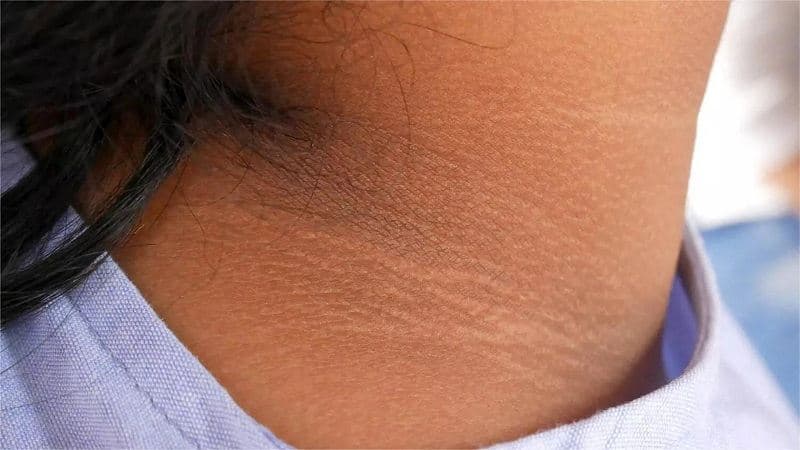 cổ đen dấu hiệu bệnh gì