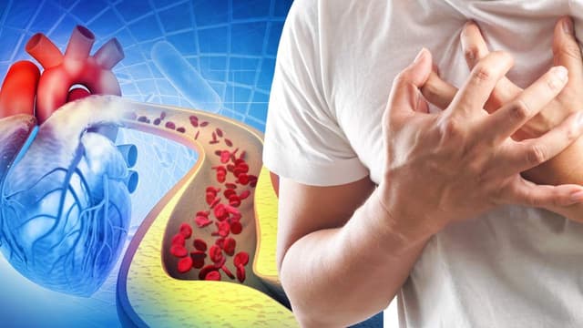 Ai cần tầm soát đột quỵ sớm? Giải đáp