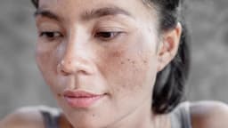 Da sạm đen dấu hiệu bệnh gì?