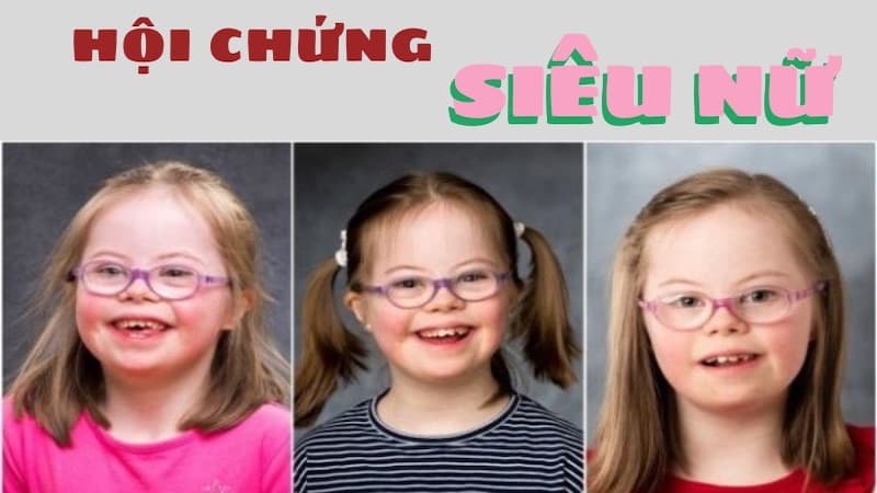 Hội chứng siêu nữ có đặc điểm gì?
