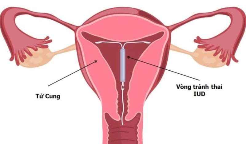 Đặt vòng có thai ngoài tử cung không?