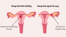 Đặt vòng có thai ngoài tử cung không?