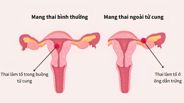 Đặt vòng có thai ngoài tử cung không?