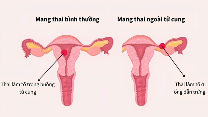 Đặt vòng có thai ngoài tử cung không?