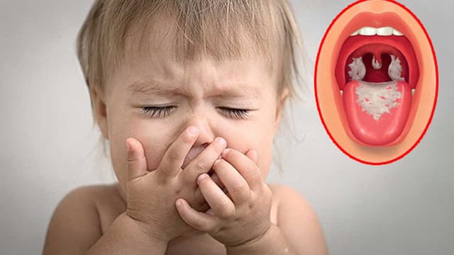 Dấu hiệu bệnh bạch hầu ở trẻ em