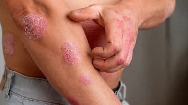 Dấu hiệu bệnh chàm da