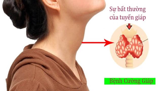 Dấu hiệu bệnh cường giáp ở nữ
