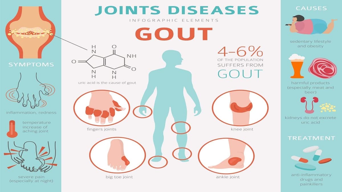 Dấu hiệu bệnh gout ở nam và nữ