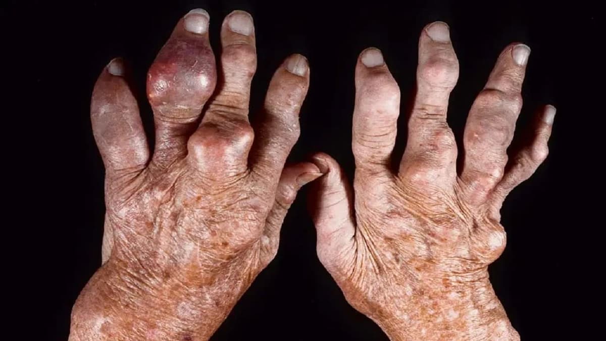 Dấu hiệu bệnh gout ở ngón tay